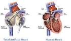 Artificial heart implant
