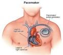 artificial pacemaker