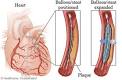 percutaneous coronary intervention