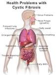 cystic fibrosis