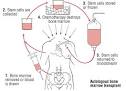 bone marrow transplant