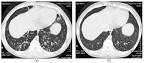 diffuse panbronchiolitis