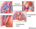 heart-lung transplant