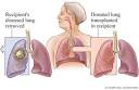 lung transplantation