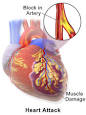 myocardial infarction